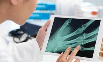 Superlijm ontwikkeld die botbreuk razendsnel kan herstellen