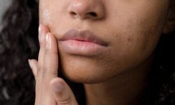 Natuurlijke middelen tegen acne en wat onderzoek erover zegt