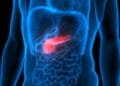 New genetic treatment for pancreatic cancer tested in Nijmegen